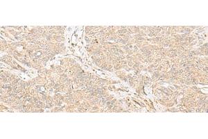 Immunohistochemistry of paraffin-embedded Human ovarian cancer tissue using TRAF6 Polyclonal Antibody at dilution of 1:30(x200) (TRAF6 anticorps)