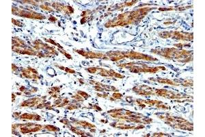 Formalin-fixed, paraffin-embedded human Leiomyosarcoma stained with SMMHC antibody (MYH11/923 + SMMS-1). (MYH11 anticorps)