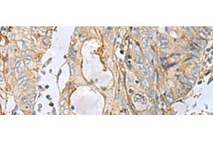Immunohistochemistry of paraffin-embedded Human colorectal cancer tissue using MTHFD2 Polyclonal Antibody at dilution of 1:65(x200) (MTHFD2 anticorps)