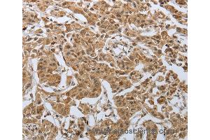 Immunohistochemistry of Human lung cancer using PSMD6 Polyclonal Antibody at dilution of 1:50
