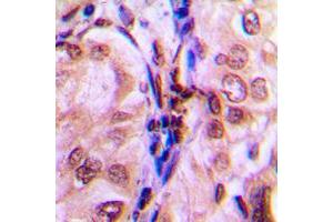 Immunohistochemical analysis of 4EBP1 (pT69) staining in human breast cancer formalin fixed paraffin embedded tissue section.