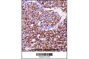 BAG2 Antibody immunohistochemistry analysis in formalin fixed and paraffin embedded human ovarian carcinoma followed by peroxidase conjugation of the secondary antibody and DAB staining. (BAG2 anticorps  (C-Term))