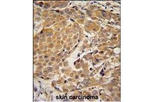 AWAT2 Antibody (C-term) (ABIN654780 and ABIN2844461) immunohistochemistry analysis in formalin fixed and paraffin embedded human skin carcinoma followed by peroxidase conjugation of the secondary antibody and DAB staining. (AWAT2 anticorps  (C-Term))
