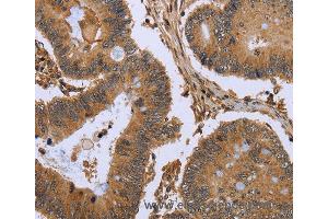 Immunohistochemistry of Human colon cancer using FHL2 Polyclonal Antibody at dilution of 1:50 (FHL2 anticorps)