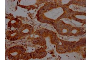 IHC image of ABIN7127483 diluted at 1:100 and staining in paraffin-embedded human colon cancer performed on a Leica BondTM system. (Recombinant FAS anticorps)