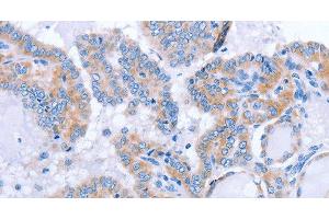 Immunohistochemistry of paraffin-embedded Human thyroid cancer tissue using FGF4 Polyclonal Antibody at dilution 1:40 (FGF4 anticorps)