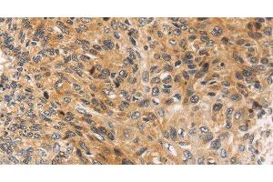 Immunohistochemistry of paraffin-embedded Human esophagus cancer using JNK2 Polyclonal Antibody at dilution of 1:30 (JNK2 anticorps)