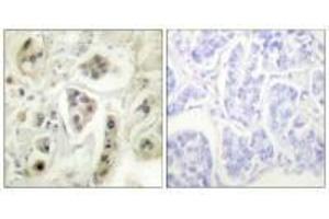 Immunohistochemical analysis of paraffin-embedded human lung carcinoma tissue using HSP60 antibody. (HSPD1 anticorps)