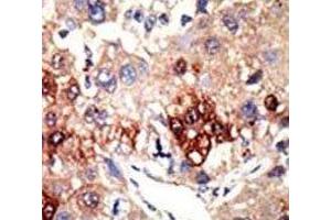 IHC analysis of FFPE human hepatocarcinoma tissue stained with the EZH2 antibody (EZH2 anticorps)