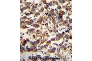 TFAM antibody (C-term) immunohistochemistry analysis in formalin fixed and paraffin embedded human testis carcinoma followed by peroxidase conjugation of the secondary antibody and DAB staining.