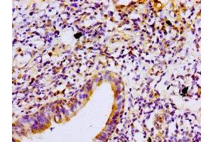 Immunohistochemistry of paraffin-embedded human lung cancer using ABIN7165698 at dilution of 1:100 (PKC beta anticorps  (AA 517-643))