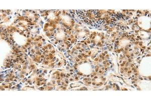 Immunohistochemistry of paraffin-embedded Human thyroid cancer using PDCD6 Polyclonal Antibody at dilution of 1:30 (PDCD6 anticorps)