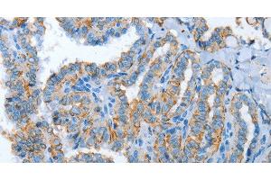 Immunohistochemistry of paraffin-embedded Human thyroid cancer tissue using ASL Polyclonal Antibody at dilution 1:35 (ASL anticorps)