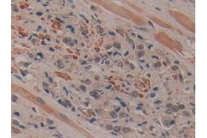 Detection of RI in Human Prostate cancer Tissue using Polyclonal Antibody to Ribonuclease Inhibitor (RI)