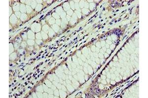 Immunohistochemistry of paraffin-embedded human colon cancer using ABIN7145038 at dilution of 1:100 (ATAD3A anticorps  (AA 1-240))
