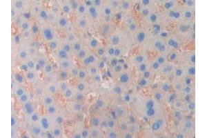DAB staining on IHC-P; Samples: Human Liver cancer Tissue (ENPP1 anticorps  (AA 625-780))