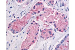 Anti-GPR87 antibody IHC of human Prostate, Carcinoma. (GPR87 anticorps  (C-Term))