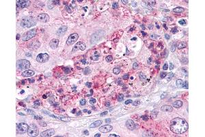 Anti-SGK3 antibody IHC of human Lung, Non-Small Cell Carcinoma. (SGK3 anticorps  (Internal Region))