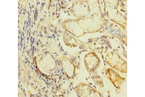 Immunohistochemistry of paraffin-embedded human gastric cancer using ABIN7157289 at dilution of 1:100 (KLHL26 anticorps  (AA 366-615))