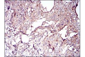 Immunohistochemical analysis of paraffin-embedded stomach cancer tissues using VIL1 mouse mAb with DAB staining.