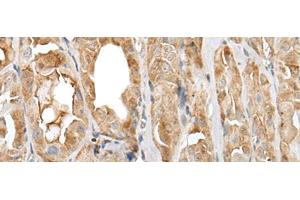 Immunohistochemistry of paraffin-embedded Human thyroid cancer tissue using PRNP Polyclonal Antibody at dilution of 1:45(x200)