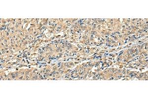 Immunohistochemistry of paraffin-embedded Human prost at e cancer tissue using CCDC112 Polyclonal Antibody at dilution of 1:45(x200)