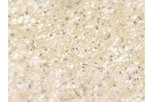 ABIN6265108 and ABIN6273319 at 1/100 staining human astrocytoma by IHC-P.
