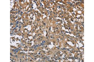 Immunohistochemistry of Human thyroid cancer using ENO1 Polyclonal Antibody at dilution of 1:40 (ENO1 anticorps)