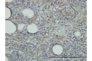 Immunoperoxidase of monoclonal antibody to PRDX2 on formalin-fixed paraffin-embedded human malignant lymphoma, diffuse large B tissue. (Peroxiredoxin 2 anticorps  (AA 1-198))