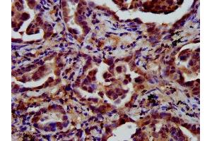 IHC image of ABIN7158226 diluted at 1:600 and staining in paraffin-embedded human lung cancer performed on a Leica BondTM system. (LIFR anticorps  (AA 915-1086))
