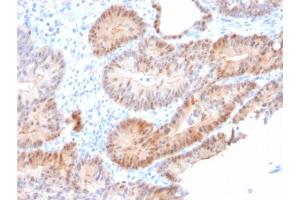 Formalin-fixed, paraffin-embedded human Prostate Carcinoma stained with AKR1C2 Mouse Monoclonal Antibody (CPTC-AKR1C2-1). (AKR1C2 anticorps)