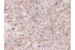 Detection of PAI1 in Human Glioma Tissue using Monoclonal Antibody to Plasminogen Activator Inhibitor 1 (PAI1)