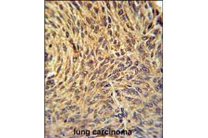 NUP210 Antibody immunohistochemistry analysis in formalin fixed and paraffin embedded human lung carcinoma followed by peroxidase conjugation of the secondary antibody and DAB staining. (NUP210 anticorps  (N-Term))
