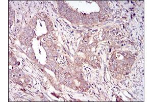 Immunohistochemical analysis of paraffin-embedded cervical cancer tissues using VTN mouse mAb with DAB staining.
