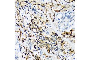 Immunohistochemistry of paraffin-embedded human lung cancer using PSMB9/LMP2 Rabbit mAb (ABIN7269596) at dilution of 1:100 (40x lens). (PSMB9 anticorps)