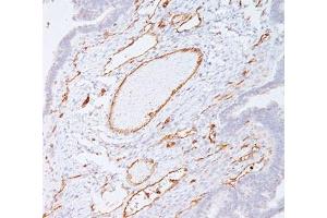 IHC staining of colon carcinoma with PECAM-1 antibody (C31. (CD31 anticorps)