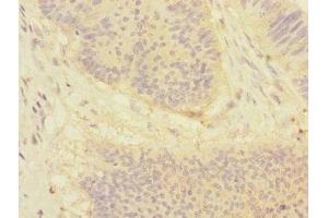 Immunohistochemistry of paraffin-embedded human colon cancer using ABIN7149768 at dilution of 1:100