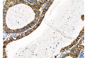 ABIN6260526 and ABIN6279316 at 1/100 staining Human ovarian cancer by IHC-P. (MCU anticorps  (Internal Region))