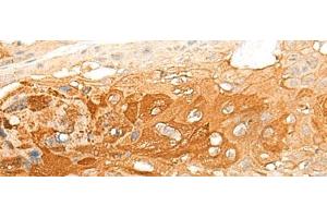 Immunohistochemistry of paraffin-embedded Human esophagus cancer tissue using DNAJC8 Polyclonal Antibody at dilution of 1:35(x200) (DNAJC8 anticorps)