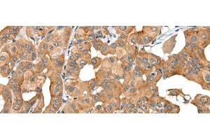 Immunohistochemistry of paraffin-embedded Human thyroid cancer tissue using INF2 Polyclonal Antibody at dilution of 1:40(x200) (INF2 anticorps)