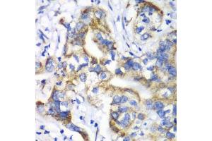 Immunohistochemistry of paraffin-embedded human liver cancer using RPL9 antibody. (RPL9 anticorps  (AA 1-192))
