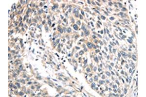 The image on the left is immunohistochemistry of paraffin-embedded Human lung cancer tissue using ABIN7191116(IQGAP2 Antibody) at dilution 1/40, on the right is treated with synthetic peptide.