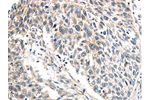 The image on the left is immunohistochemistry of paraffin-embedded Human lung cancer tissue using ABIN7191116(IQGAP2 Antibody) at dilution 1/40, on the right is treated with synthetic peptide. (IQGAP2 anticorps)