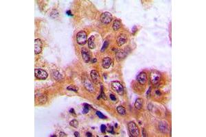 Immunohistochemical analysis of SGK1 staining in human lung cancer formalin fixed paraffin embedded tissue section.