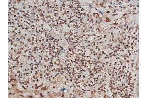 ABIN6267415 at 1/200 staining human breast cancer tissue sections by IHC-P.