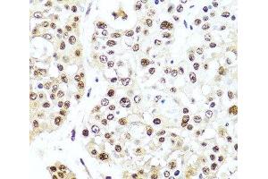 Immunohistochemistry of paraffin-embedded Human colon carcinoma using TET2 Polyclonal Antibody at dilution of 1:100 (40x lens).