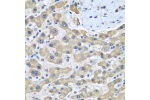 Immunohistochemistry of paraffin-embedded human liver cancer using GFM1 antibody at dilution of 1:100 (40x lens). (GFM1 anticorps)
