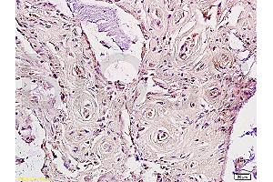 Formalin-fixed and paraffin embedded human rectal carcinoma labeled Anti-LDL receptor Polyclonal Antibody, Unconjugated (ABIN672111) at 1:200, followed by conjugation to the secondary antibody and DAB staining (LDLR anticorps  (AA 781-860))