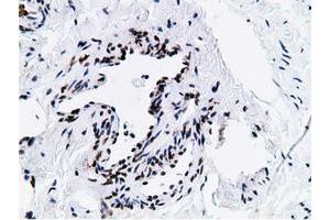Immunohistochemical staining of paraffin-embedded Carcinoma of Human kidney tissue using anti-NT5DC1 mouse monoclonal antibody. (NT5DC1 anticorps)