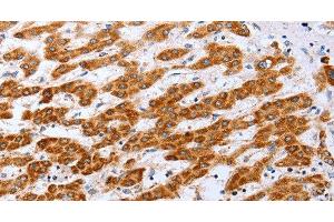 Immunohistochemistry of paraffin-embedded Human liver cancer tissue using Claudin 10 Polyclonal Antibody at dilution 1:50 (CLDN10 anticorps)